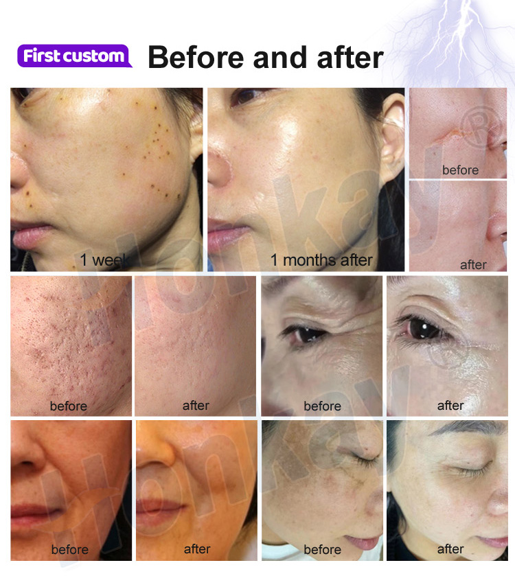 plasma pen fibroblast