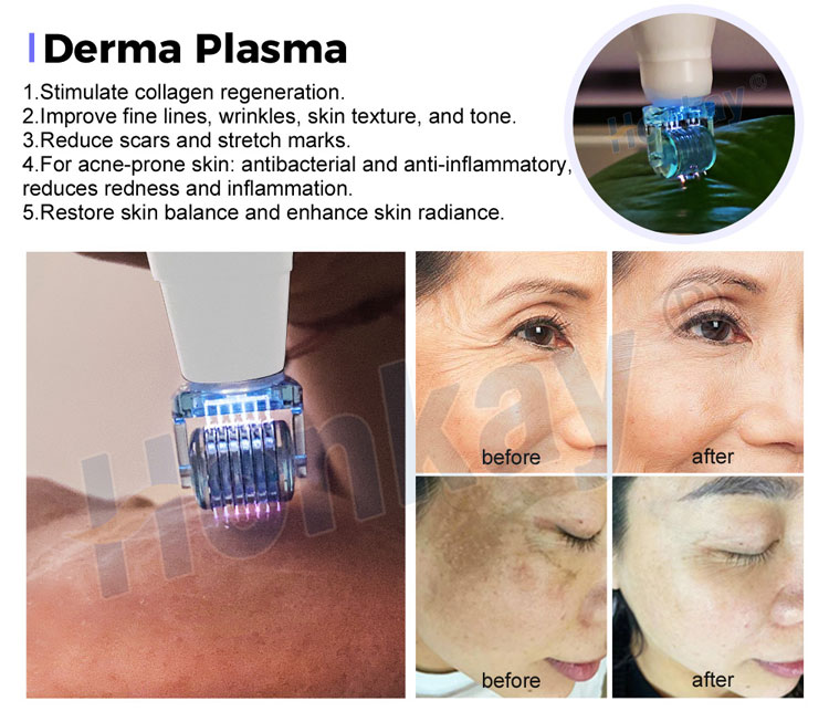 cold plasma machine