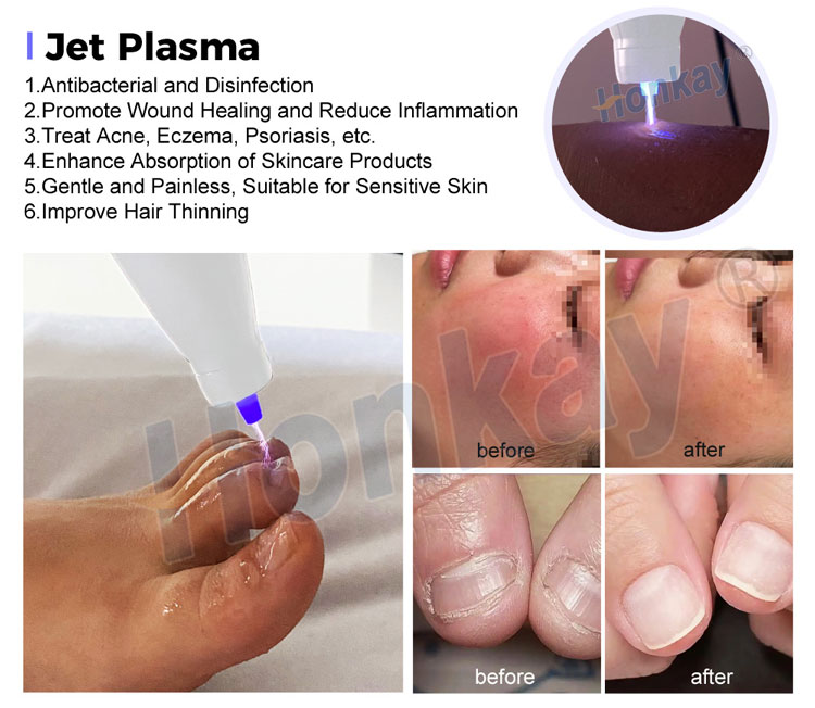 cold plasma machine