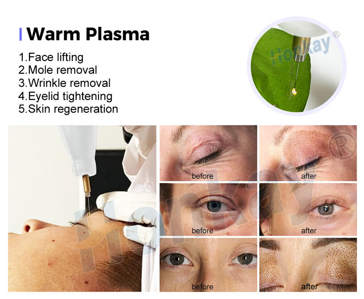 cold plasma machine