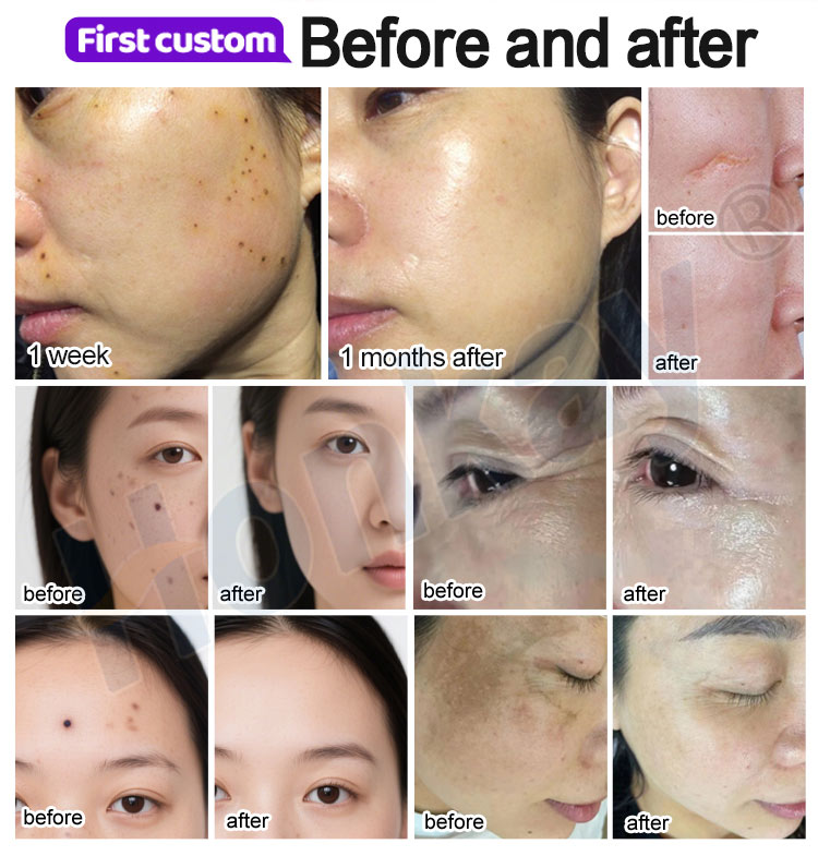 plasma pen eye lift for safe