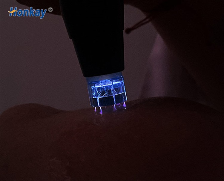 cold plasma discharge from a handpiece tip
