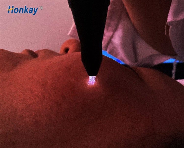 warm plasma mode working close to the skin surface