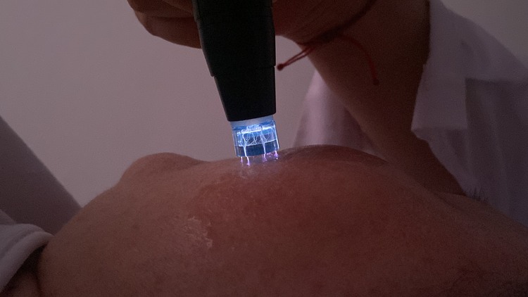 cold plasma pen applied below the jawline during a treatment