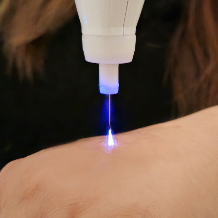 cold plasma pen held against the skin during treatment