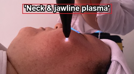 cold plasma treatment for the neck and jawline